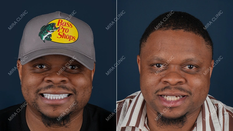 Before and After Veneers